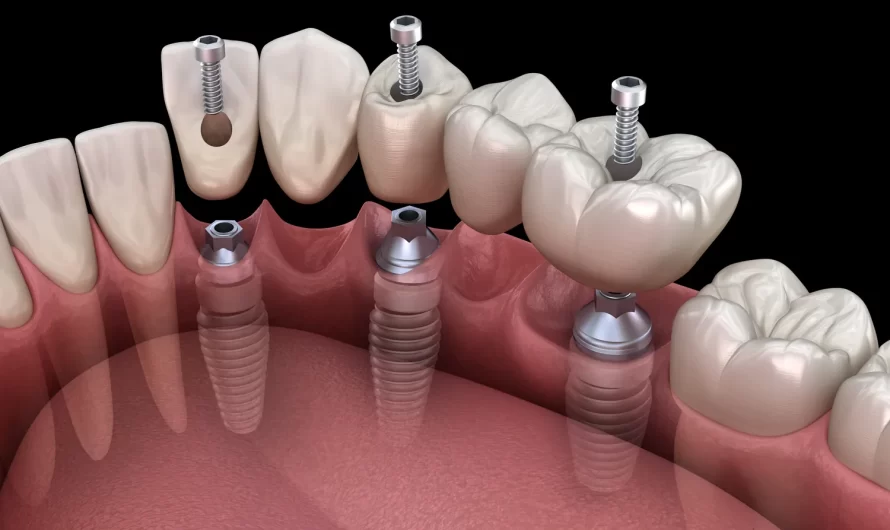 Jaki jest koszt implantów całej szczęki?