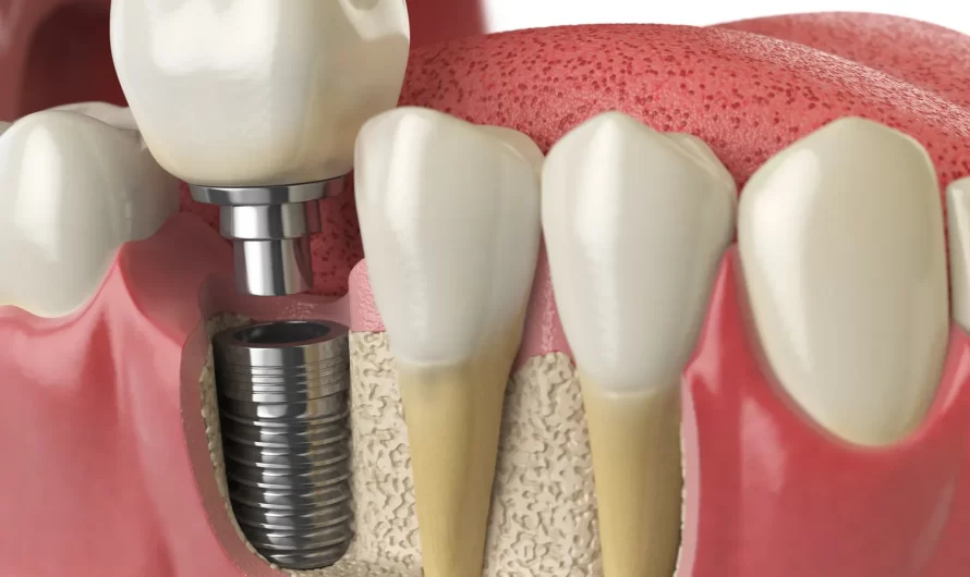 Dentysta Szczecin implanty